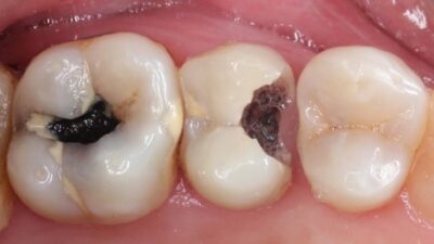 bahan alami menghilangkan sakit gigi