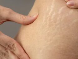 Enam Cara Alami Menghilangkan Stretch Mark dengan Bahan Rumahan