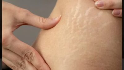 Enam Cara Alami Menghilangkan Stretch Mark dengan Bahan Rumahan