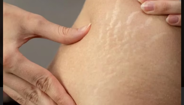 Cara menghilangkan Stretch Mark