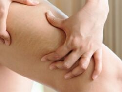 Stretch Mark pada Remaja: Cara Mencegah dan Merawatnya