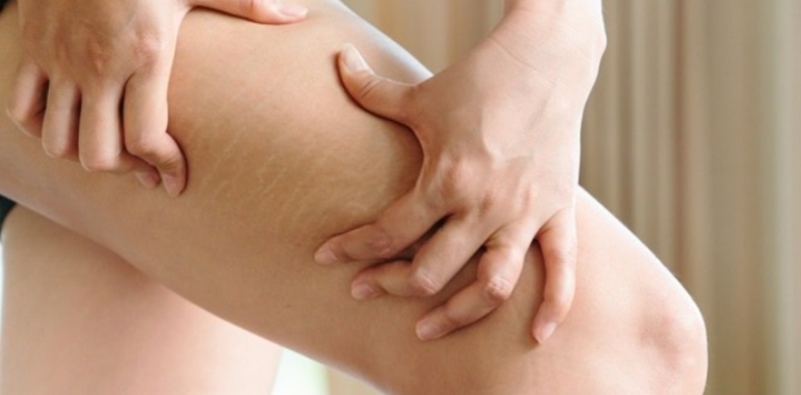 Stretch Mark pada Remaja