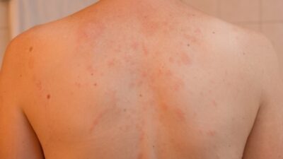 Pityriasis Rosea