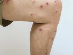 Leishmaniasis: Penyebab, Gejala, dan Cara Pengobatannya