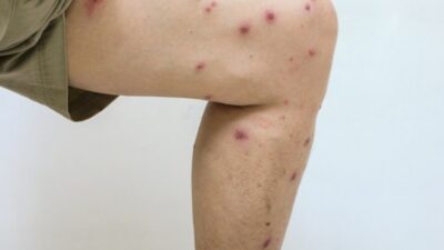 Leishmaniasis