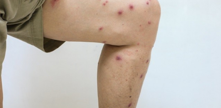 Leishmaniasis