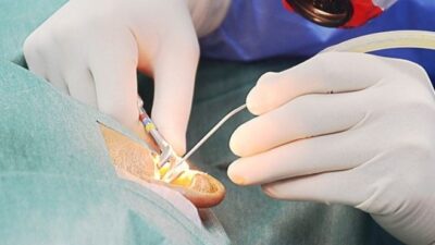 prosedur myringotomy