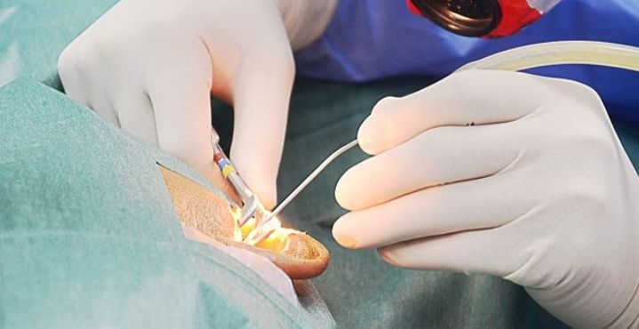 prosedur myringotomy