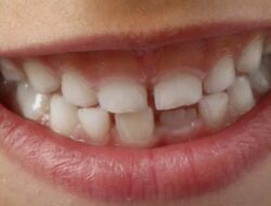 Mengatasi Gigi Renggang: Penyebab, Solusi, dan Perawatan yang Efektif