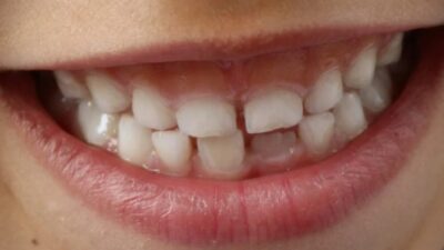 Mengatasi Gigi Renggang