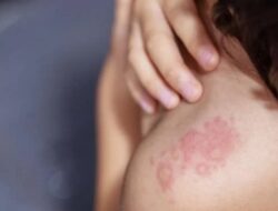 Cara Mengatasi dan Meredakan Gigitan Tomcat: Langkah Pertolongan Pertama dan Pencegahan