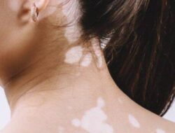 Vitiligo: Penyebab, Gejala, dan Pengobatan Penyakit Kulit yang Menyebabkan Hilangnya Pigmen Warna