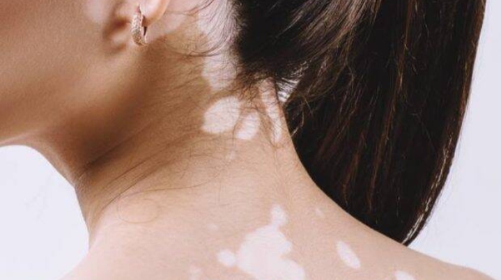 Vitiligo: Penyebab, Gejala, dan Pengobatan Penyakit
