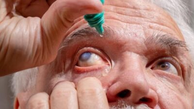 Pilihan Obat Glaukoma