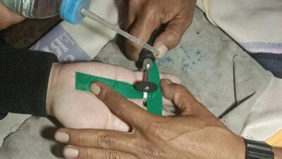 pembengkakan jari tangan karena cincin