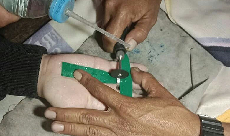 pembengkakan jari tangan karena cincin