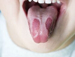 Mengenal Geographic Tongue: Gejala, Penyebab, dan Cara Mengatasi