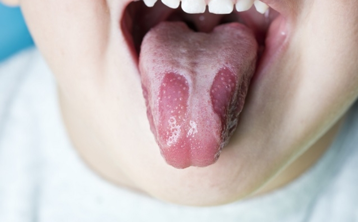 Mengenal Geographic Tongue