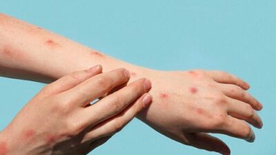 Waspada! Kasus Cacar Monyet Telah Terdeteksi di Bandung